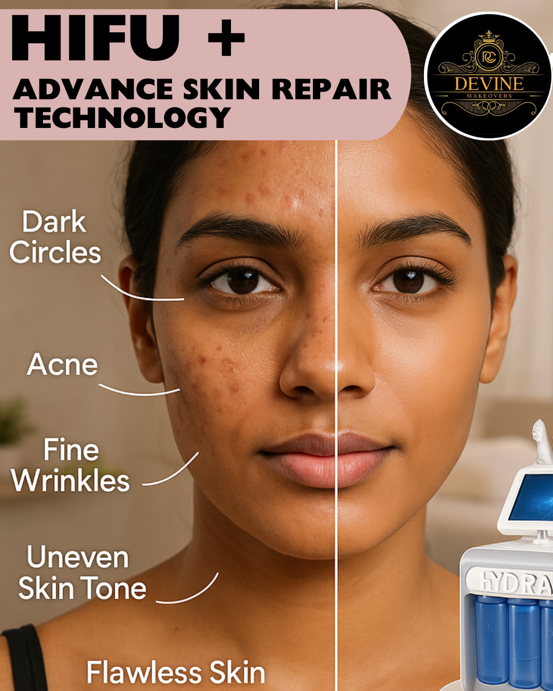 HIFU Advance Face Treatment
